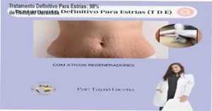 Curso de tratamento definitivo para estrias com resultados de 98% reduzidos