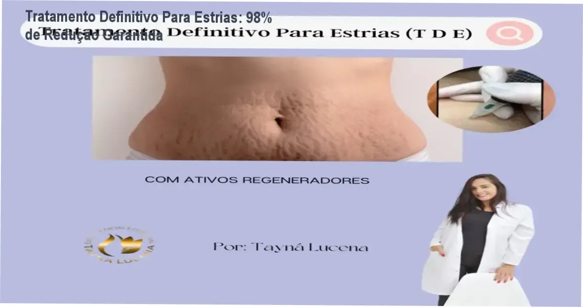Curso de tratamento definitivo para estrias com resultados de 98% reduzidos